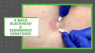 A Back Blackhead amp Seborrheic Keratoses  Dr Derm [upl. by Lukasz243]