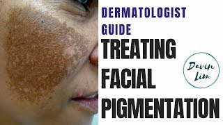 How to treat PIGMENTATION [upl. by Truman]