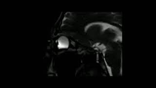 Eye movement during MRI [upl. by Lim]