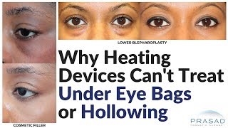 Why Radiofrequency or Laser Devices Cant Treat Under Eye Bags or Hollowing [upl. by Aihsitan]