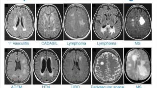 MRI Uses in MS [upl. by Ced]